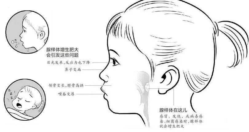 问止中医 | 医案：小儿腺样体肥大、鼻炎、鼻窦炎、打鼾-第9张图片-天天中医网